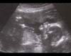 Caroline Byrne's baby scan thumbnail