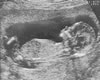 Kate Thompson's baby scan
