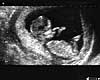 Andrea Price's 12 week scan