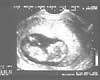 Sonia Dalton's baby scan thumbnail